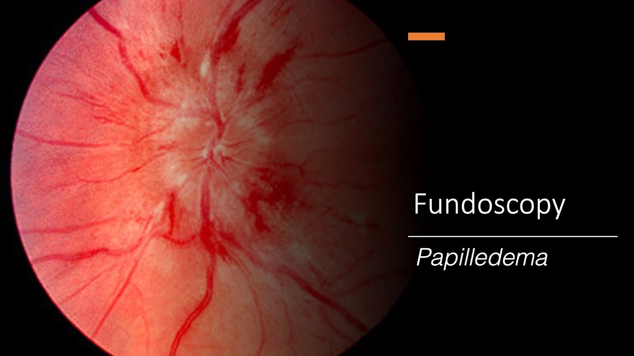Papilledema: Fundoscopy