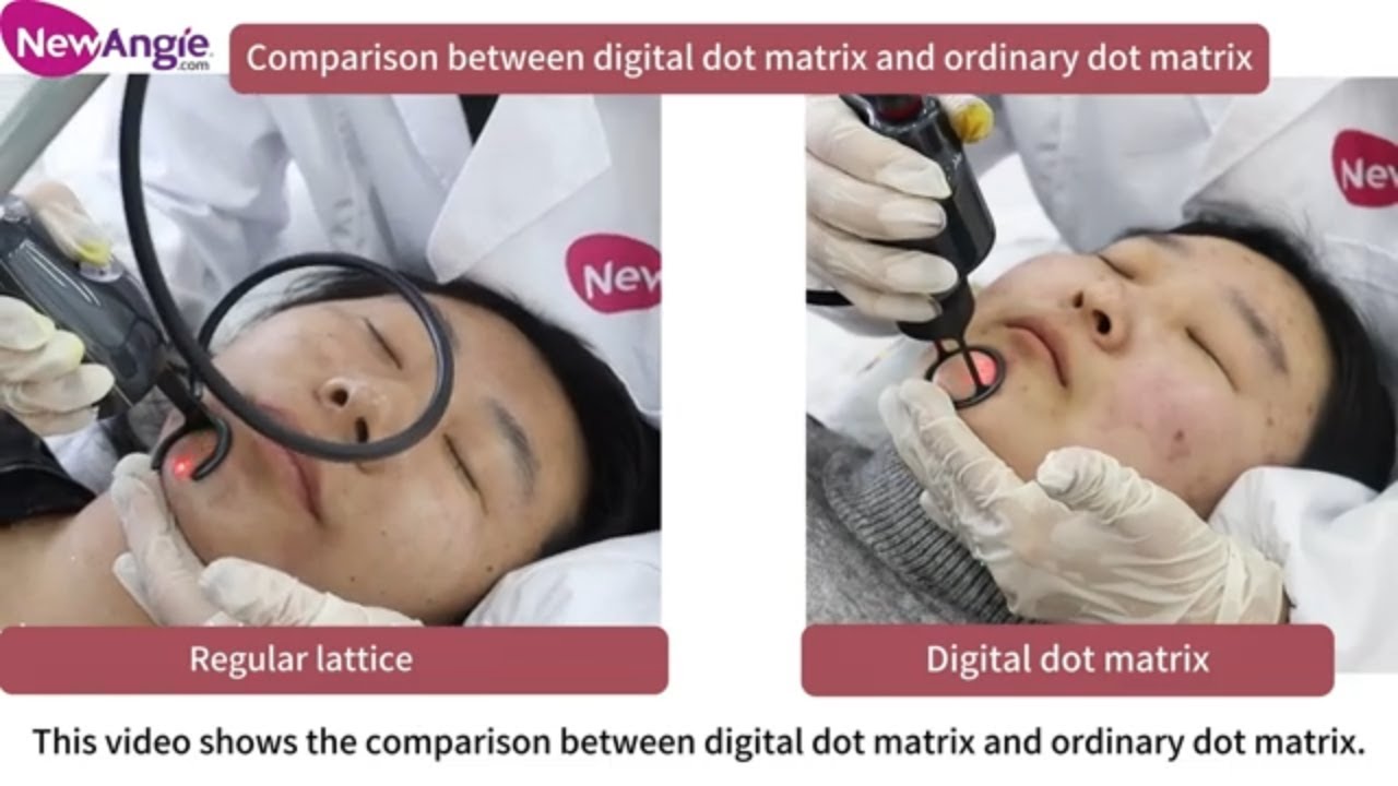 Digital Fractional vs. Standard Fractional Laser | Treatment Comparison Demo