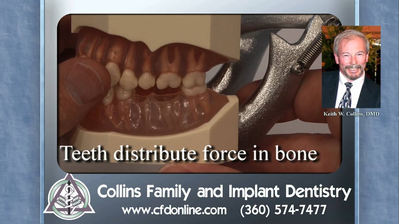 How teeth distribute force deep in bone, missing teeth focus stress, nutracker analogy