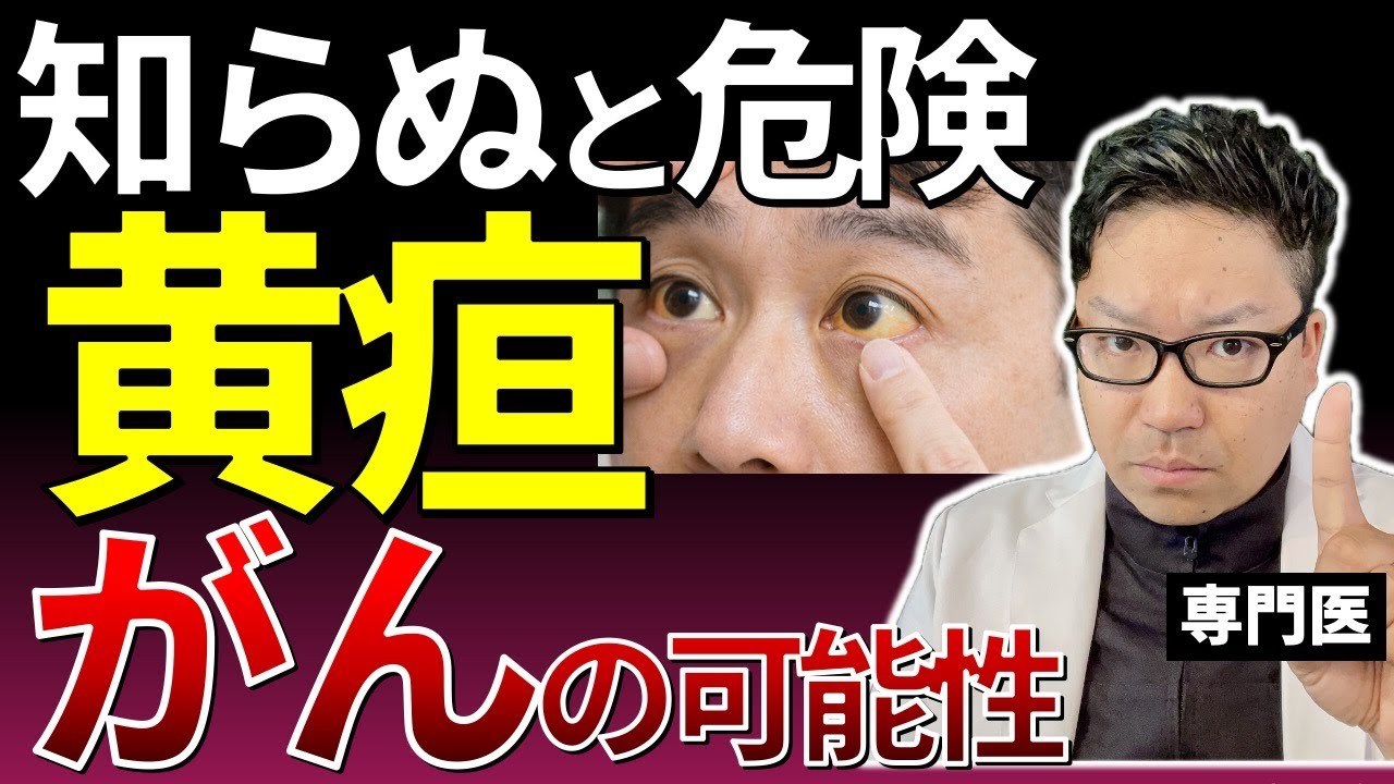 知らぬと危険な黄疸｜白目チェックでわかる病気とがんの可能性【専門医解説】