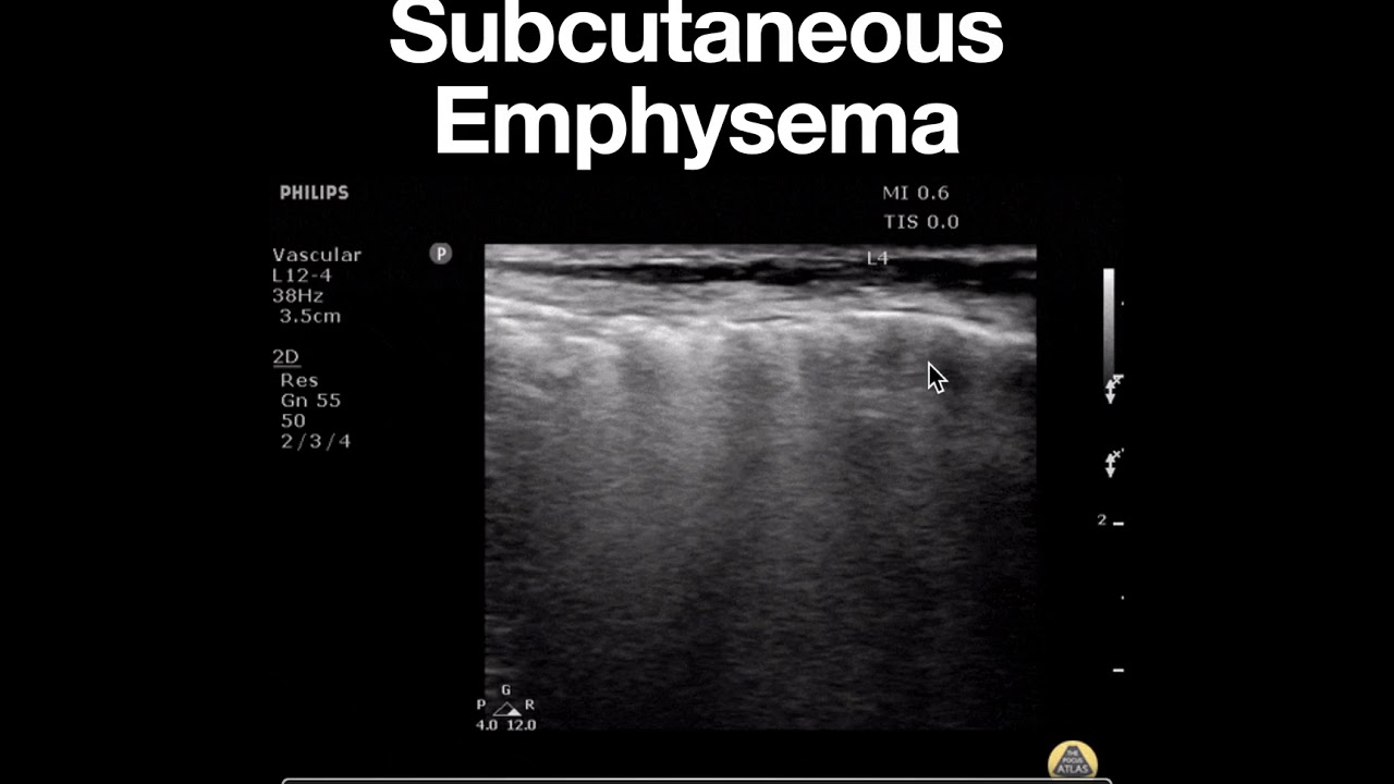Subcutaneous Emphysema