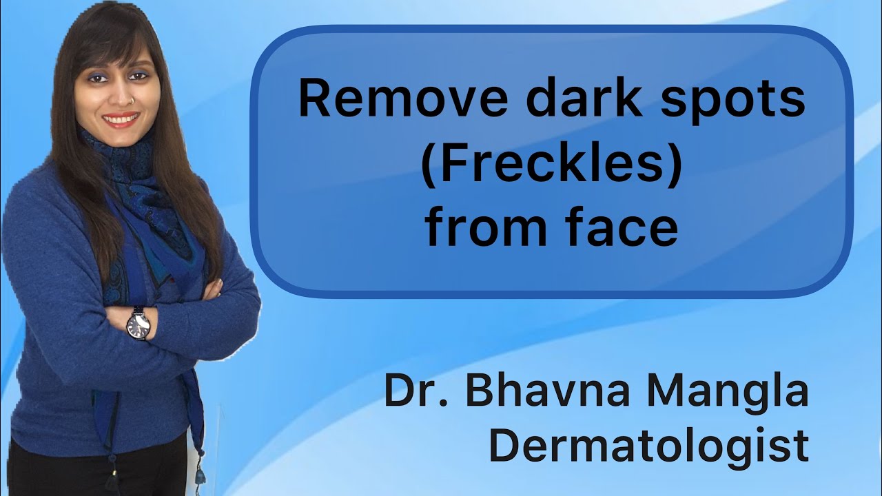 How to Get Rid of Freckles or Brown Spots | Freckles | Dark Brown Spots
