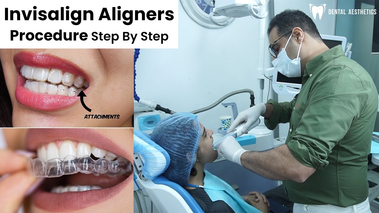 Invisalign Aligners Procedure Step by Step Explained Including Attachments | Urdu/Hindi