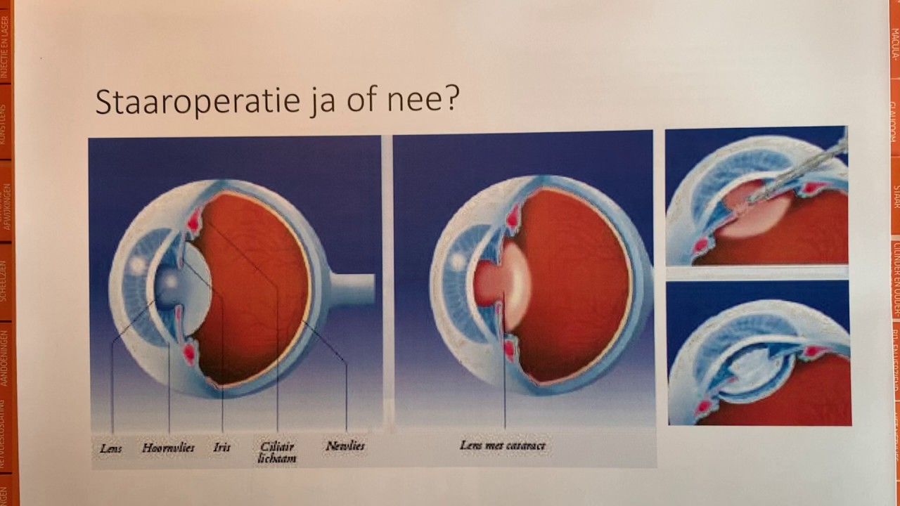 Staaroperatie ja of nee?