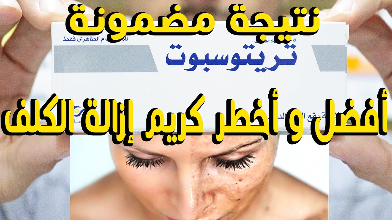 أفضل كريم لإزالة الكلف والتصبغات فوائده مذهلة نتيجة مضمونة ومخاطر كبيرا تريتوسبوت Tritospot Cream