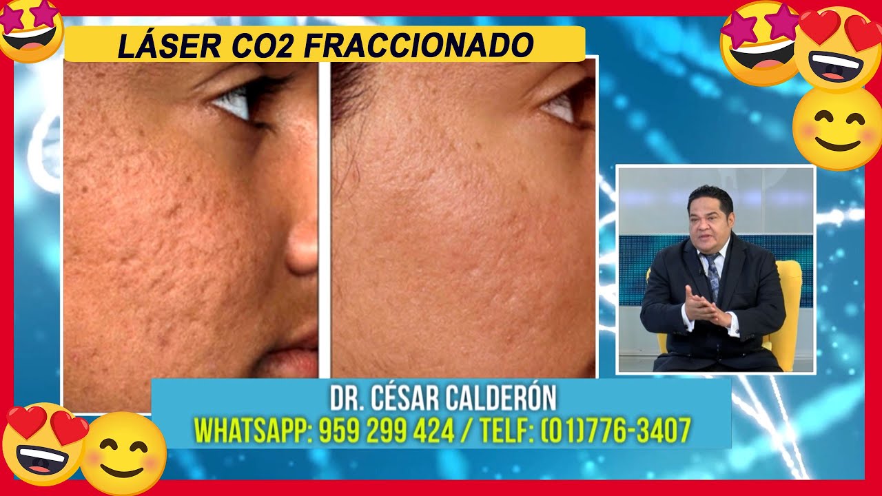 #𝗟𝗔́𝗦𝗘𝗥 𝗖𝗢𝟮 𝗙𝗥𝗔𝗖𝗖𝗜𝗢𝗡𝗔𝗗𝗢 #𝗗𝗘𝗞𝗔