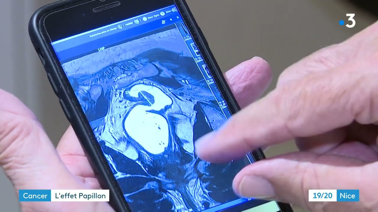 A Nice, une machine unique au monde permet de stériliser les tumeurs liées au cancer colorectal