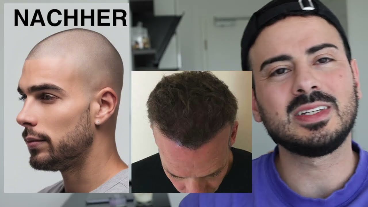 Haarpigmentierung | Kosten, Nachteile & Ergebnisse | Haarausfall