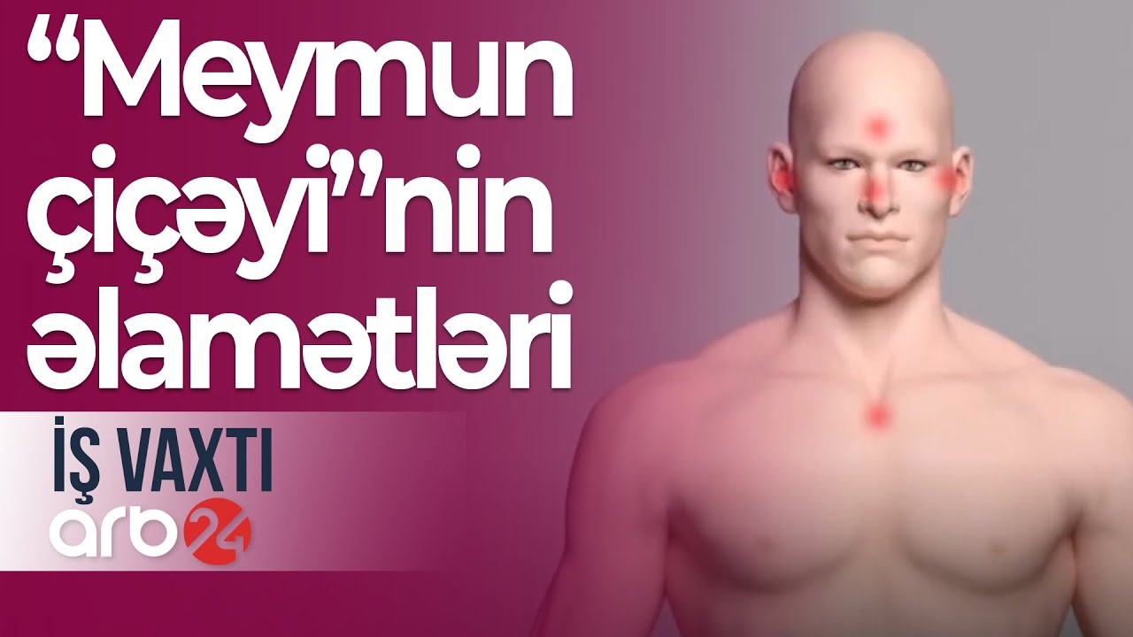 Dünya üçün yaranan yeni təhlükə: “Meymun çiçəyi”nin əlamətləri nələrdir? - İş vaxtı