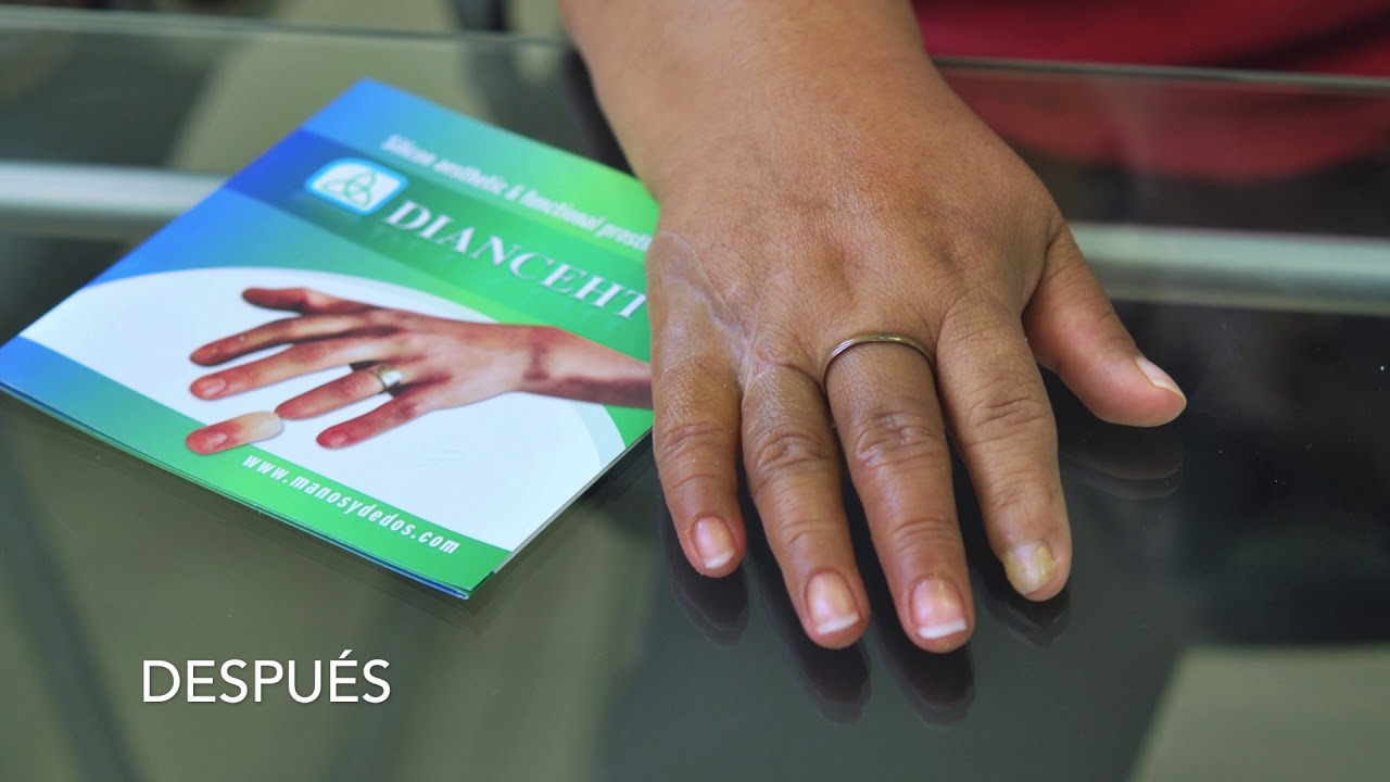 Prótesis para dedos de la mano, Finger prosthesis, Full HD 1080p No  180