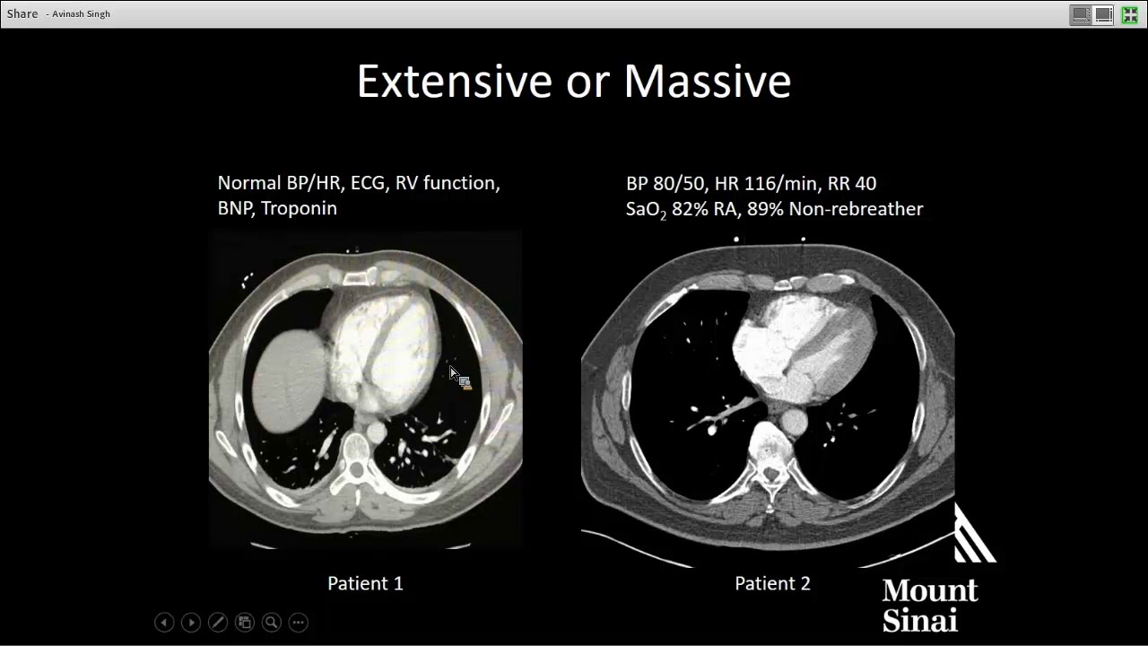 Endovascular Therapy for Acute Pulmonary Embolism