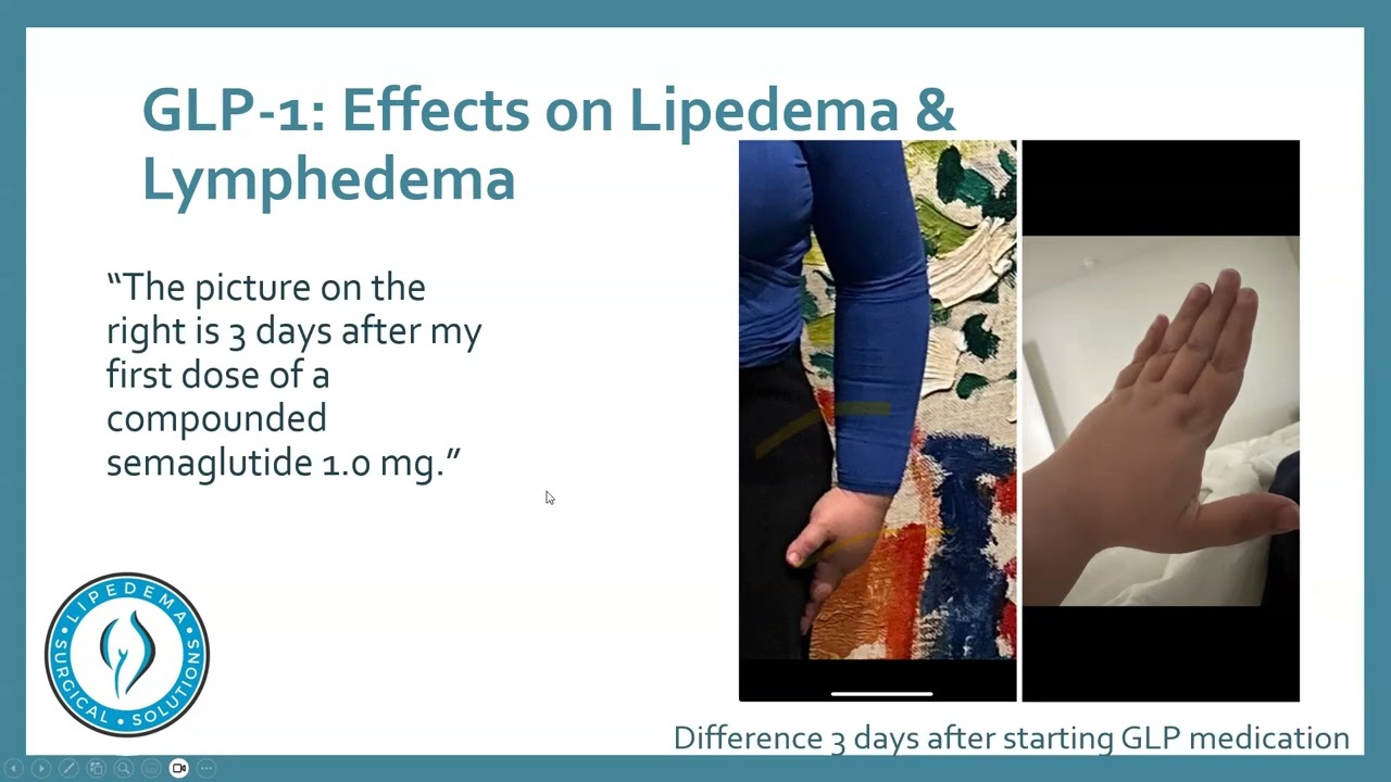 GLP-1 & Lipedema: Dr. Wright & Sara Discuss Effects, Mechanisms, and Weight Loss Program