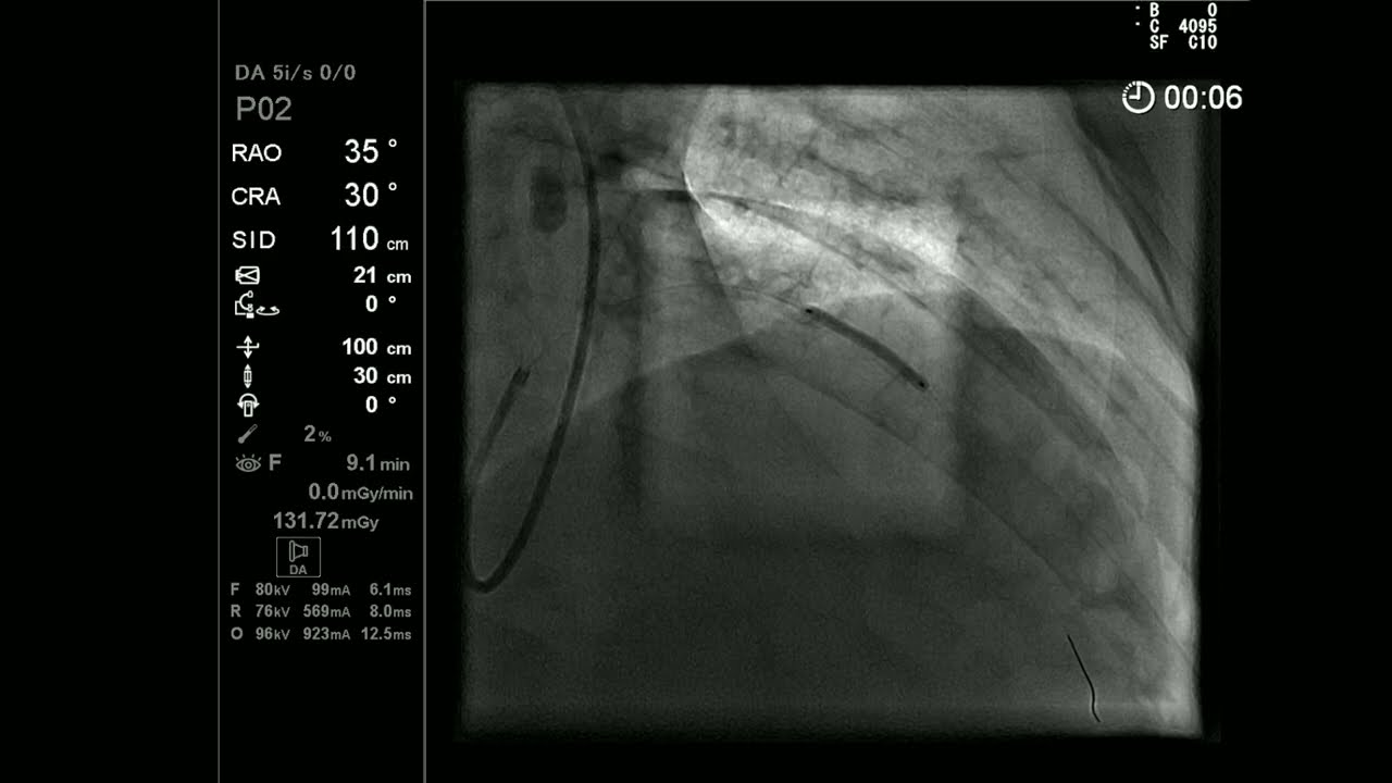 Désobstruction d'une CTO de l'IVA associée au rotablator par Dr Christophe ROBIN 🫀