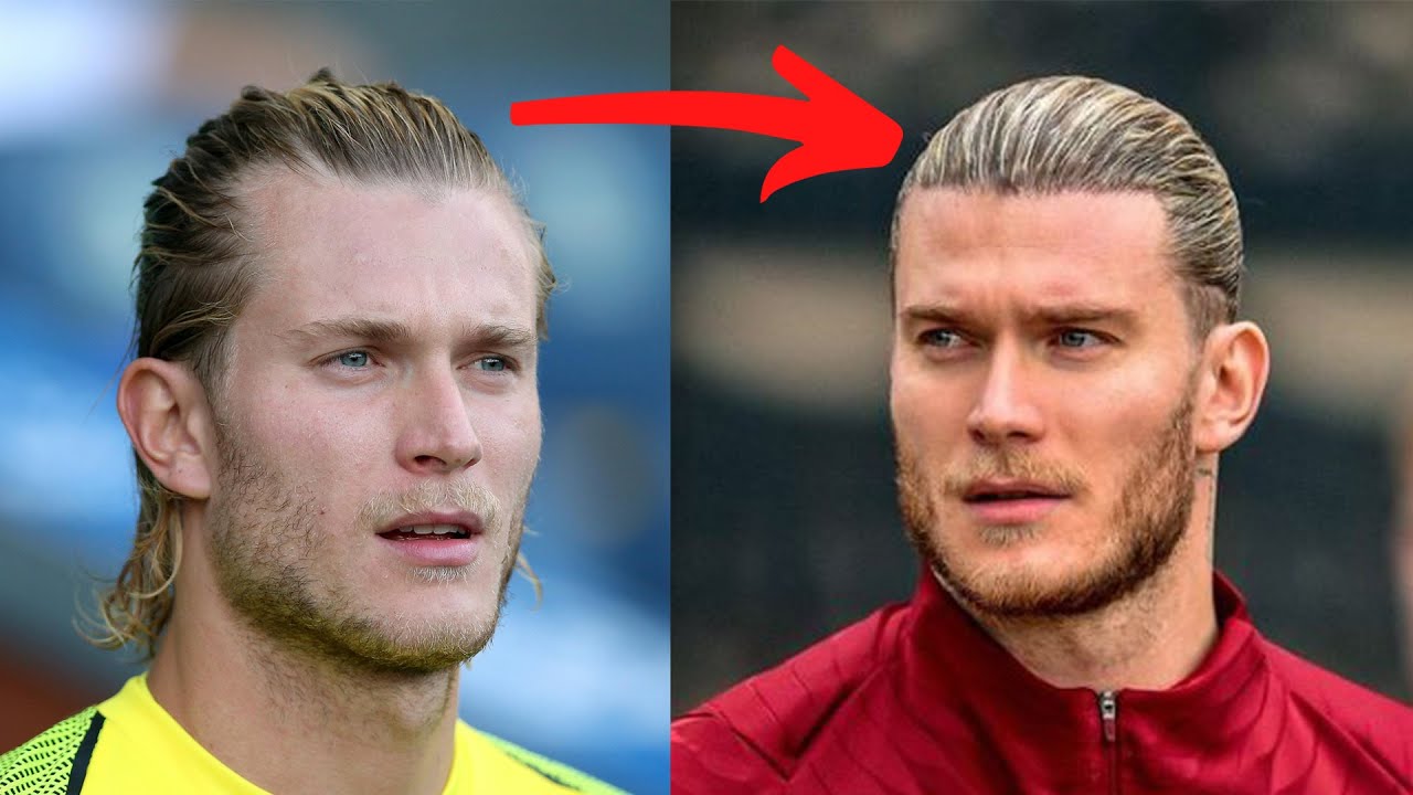 Loris Karius Hair Transplant Transformation! My Breakdown PART 1