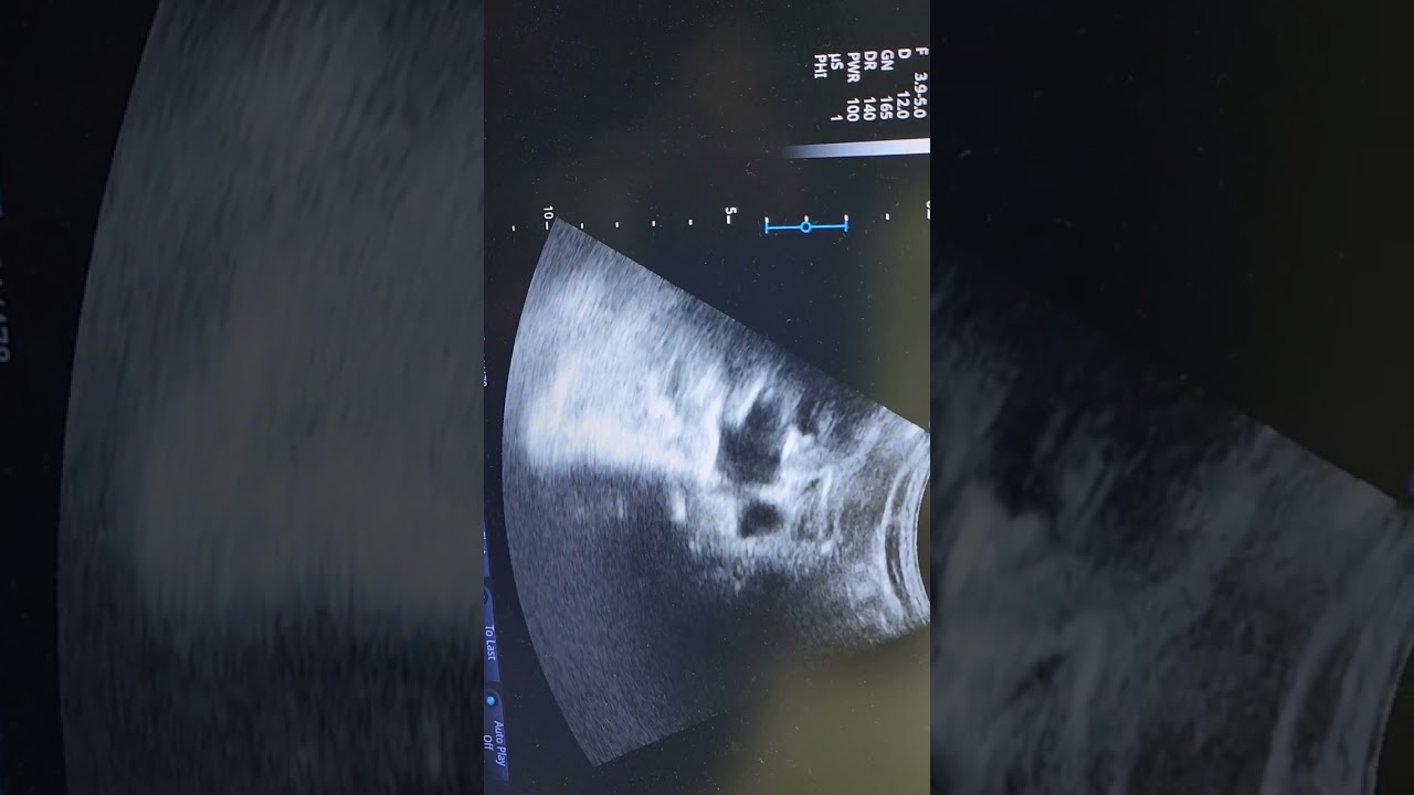 تعليم السونار وحاله جميله حصوه في الحالب وارتجاع ميه على الكلىlower ureteric stone ė marked HN