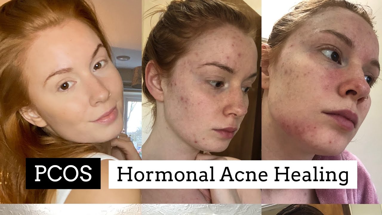 How I healed my PCOS Hormonal Acne Naturally || No Accutane *Planet Friendly Skincare Routine