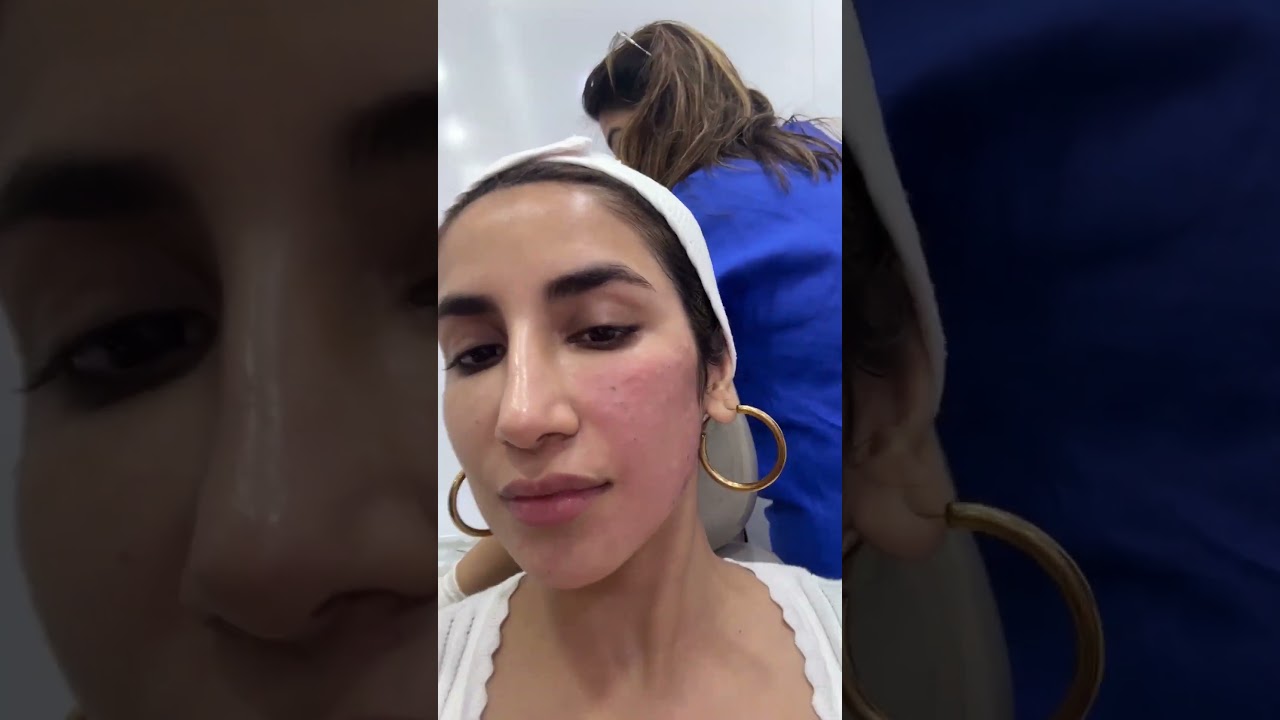 PDRN Skin boosters: The secret to firm, glowing, younger-looking skin.💉
