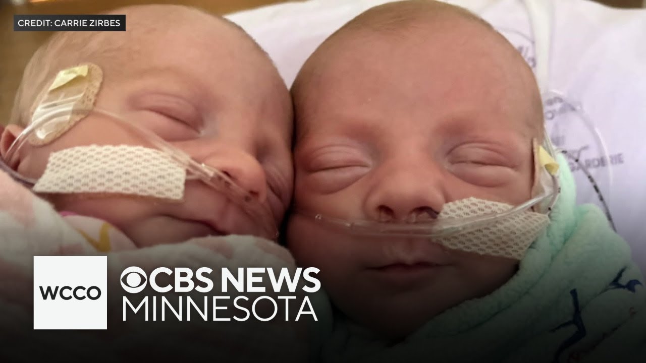 Minnesota woman gives birth to ultra rare mono mono twins