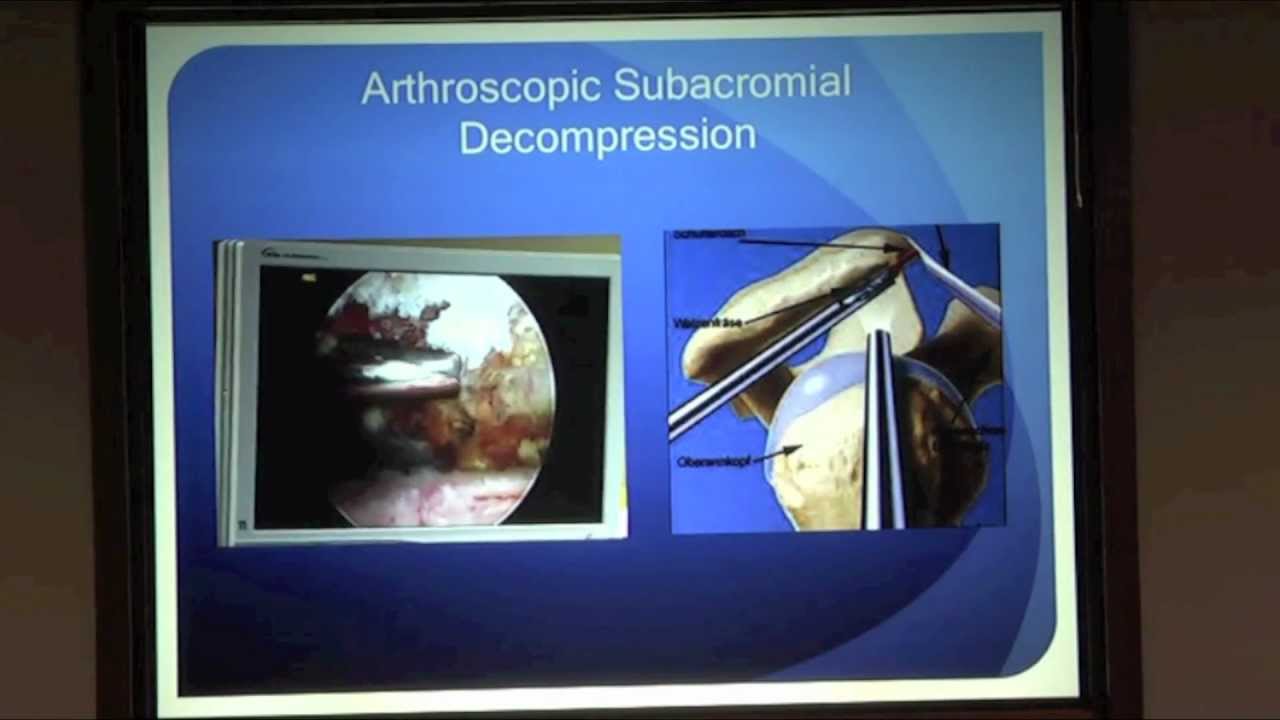 Why Does My Shoulder Hurt? Part 2 Dr. Eric Janssen