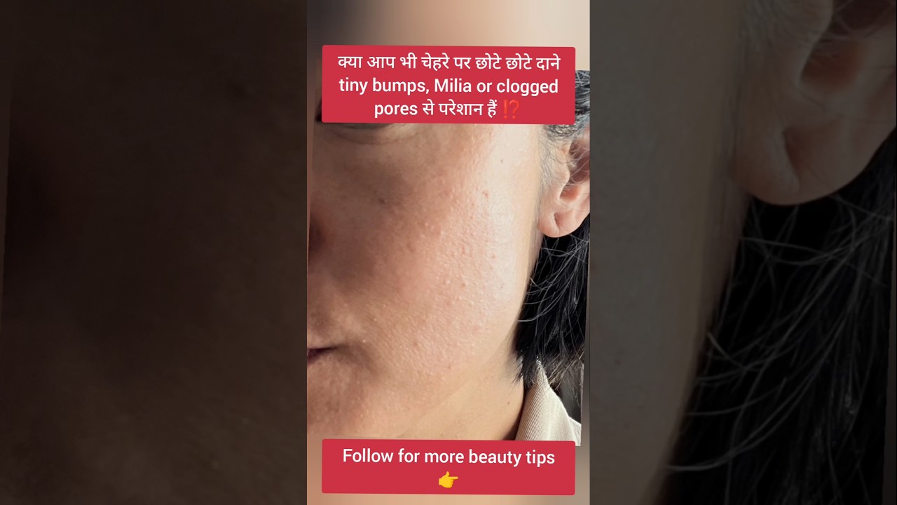 Are you also troubled by tiny bumps, Milia or clogged pores on your face? #shorts #skin