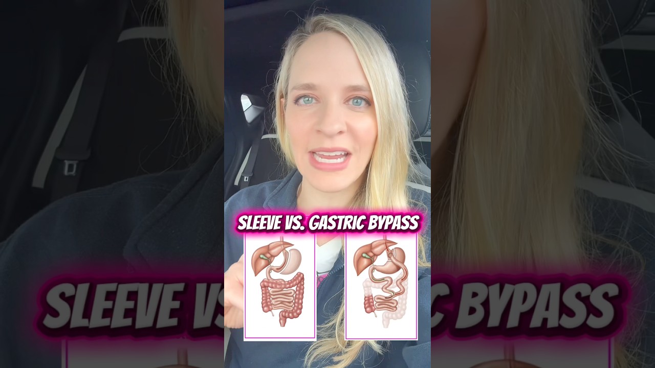 Sleeve or Gastric Bypass: which is better?
