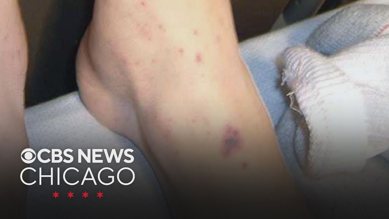 Chicago health officials warn of meningitis outbreak, 2 deaths already reported
