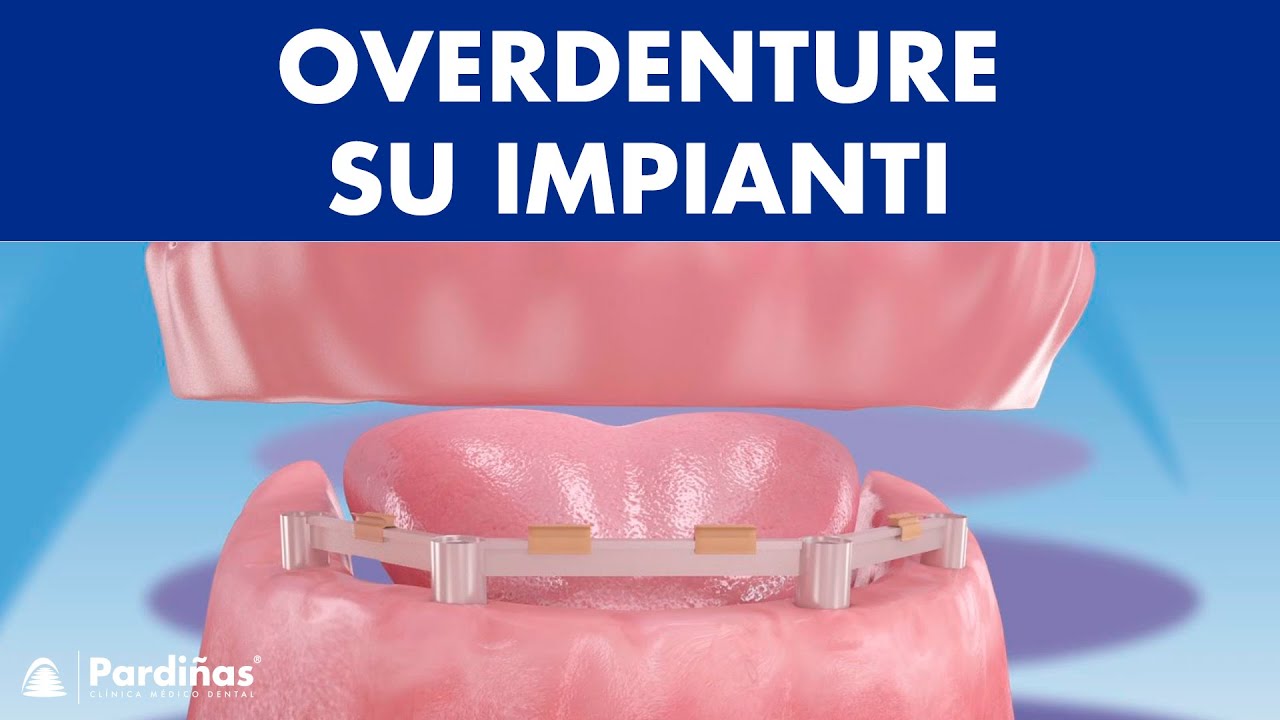 Overdenture su impianti ©