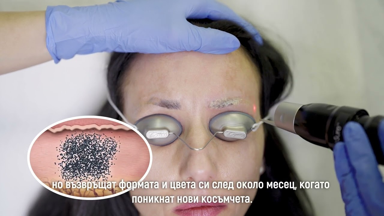 Picosure® - Премахване на перманентен грим