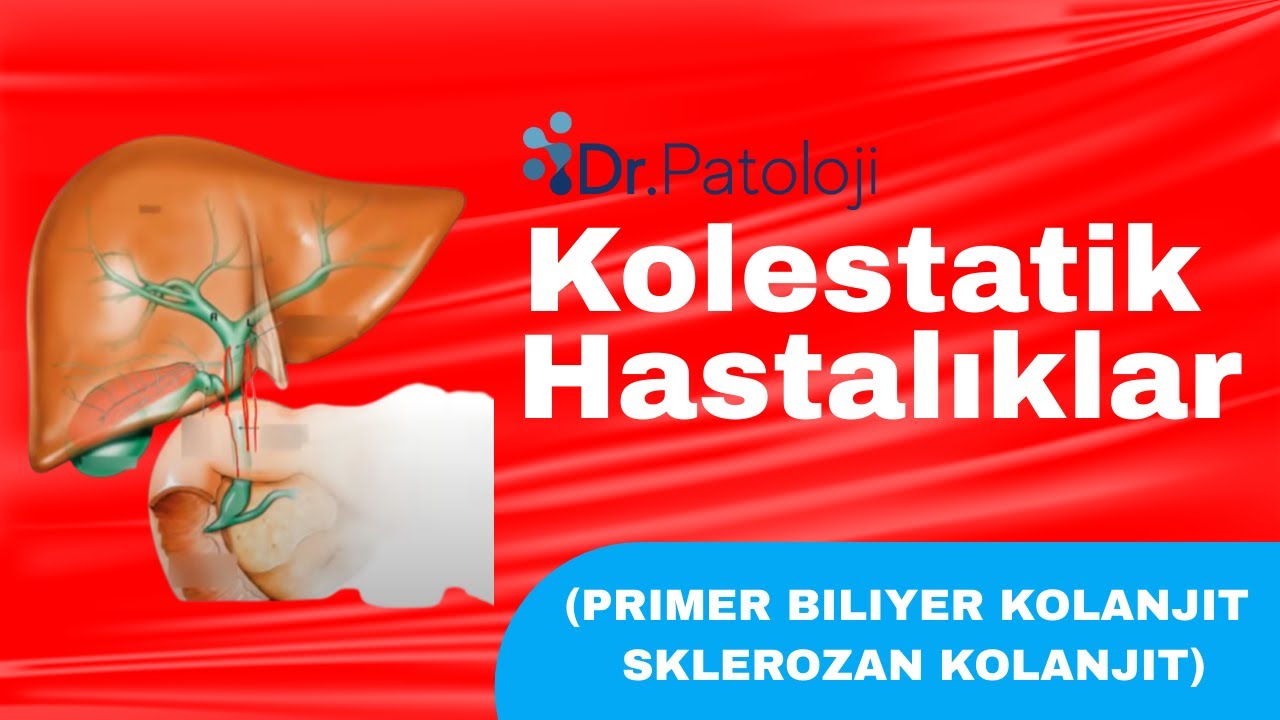 Her TUS soru gelen bir konu. Kolestatik Hastalıklar (Primer Biliyer Kolanjit- Sklerozan Kolanjit)