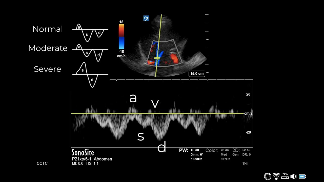 How to... Obtain a Hepatic Vein Waveform