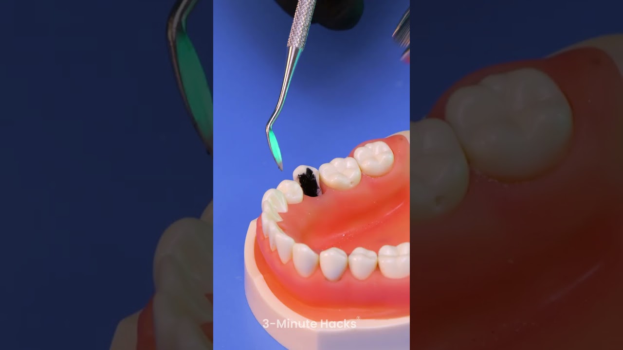How tooth removal works at the dentist