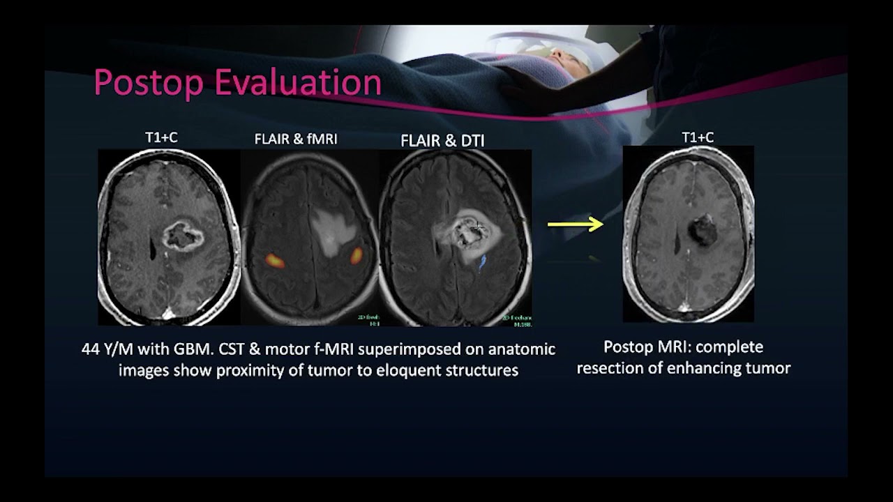 Imaging of High grade glioma