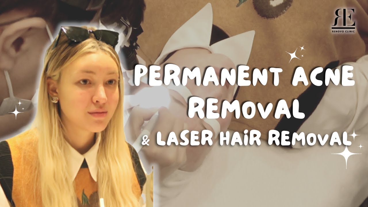 Permanent Acne Removal and Laser Hair Removal in Korea #skincare #laser #korea