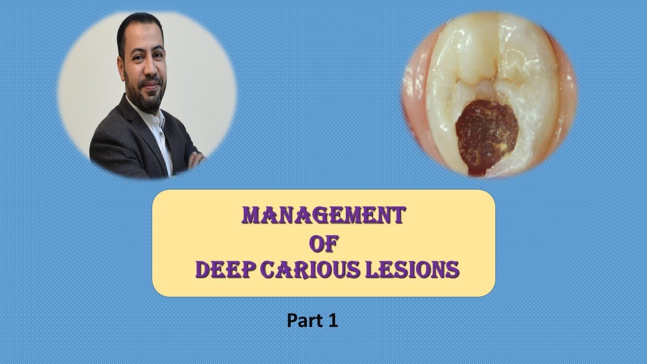 Management of deep carious lesions (part 1)