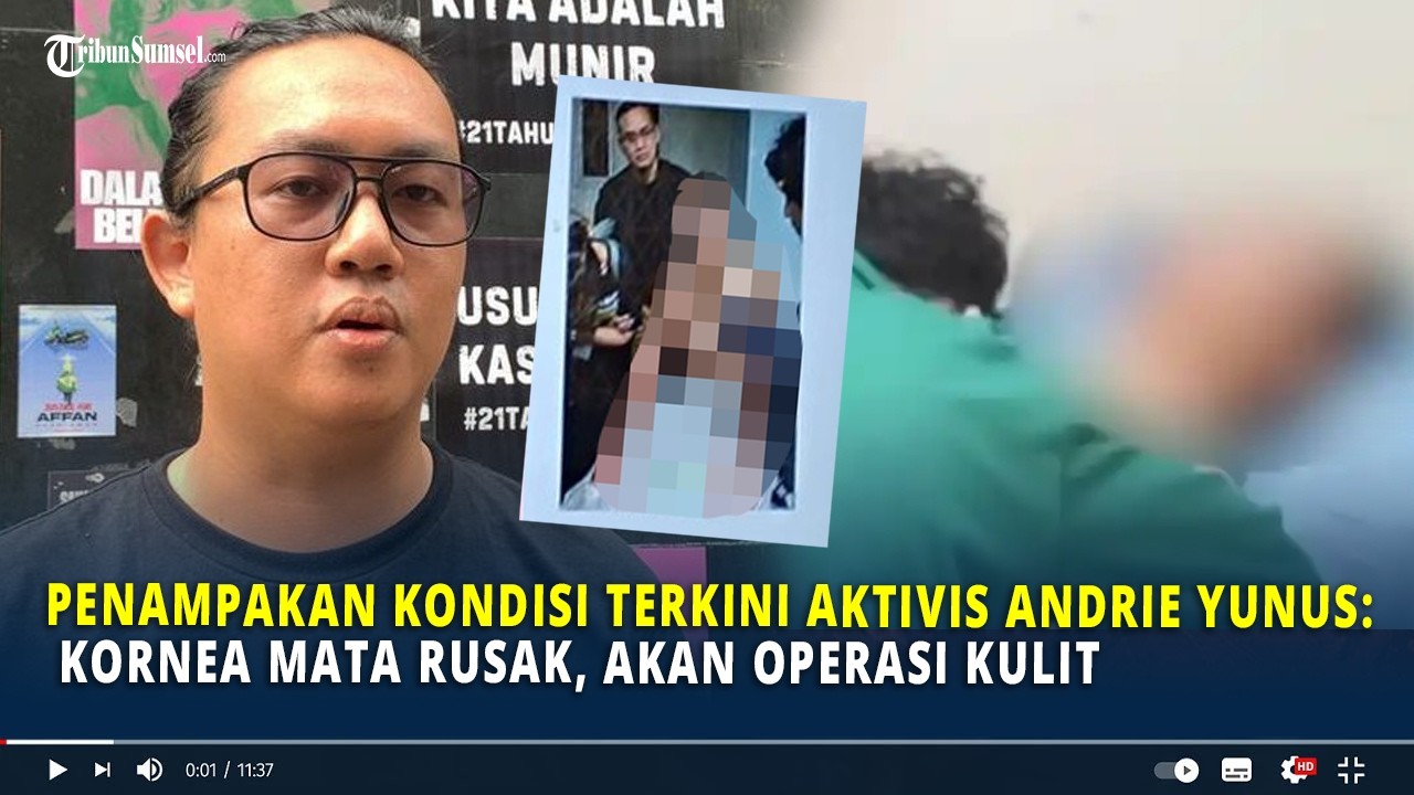 Penampakan Kondisi Terkini Aktivis Andrie Yunus: Kornea Mata Rusak, Akan Operasi Kulit