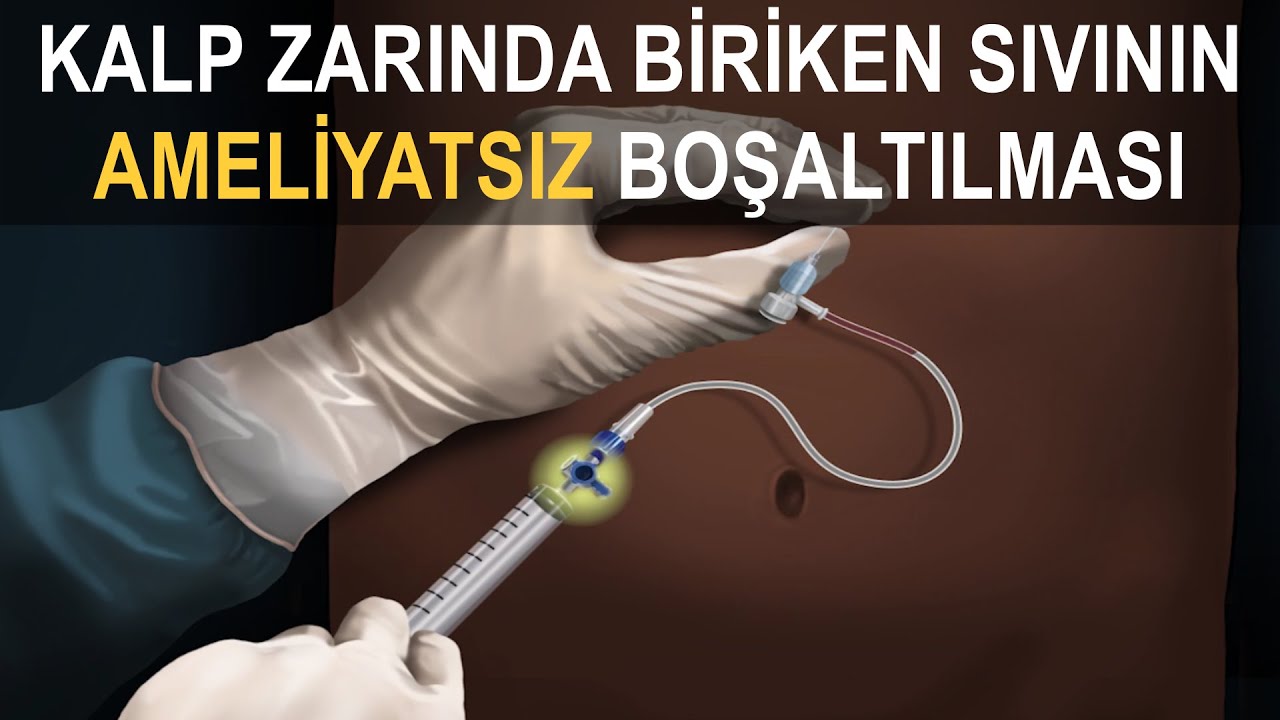 KALP ZARINDA BİRİKEN SIVININ BOŞALTILMASI (Perikardiyosentez ve Balon Perikardiyotomi)