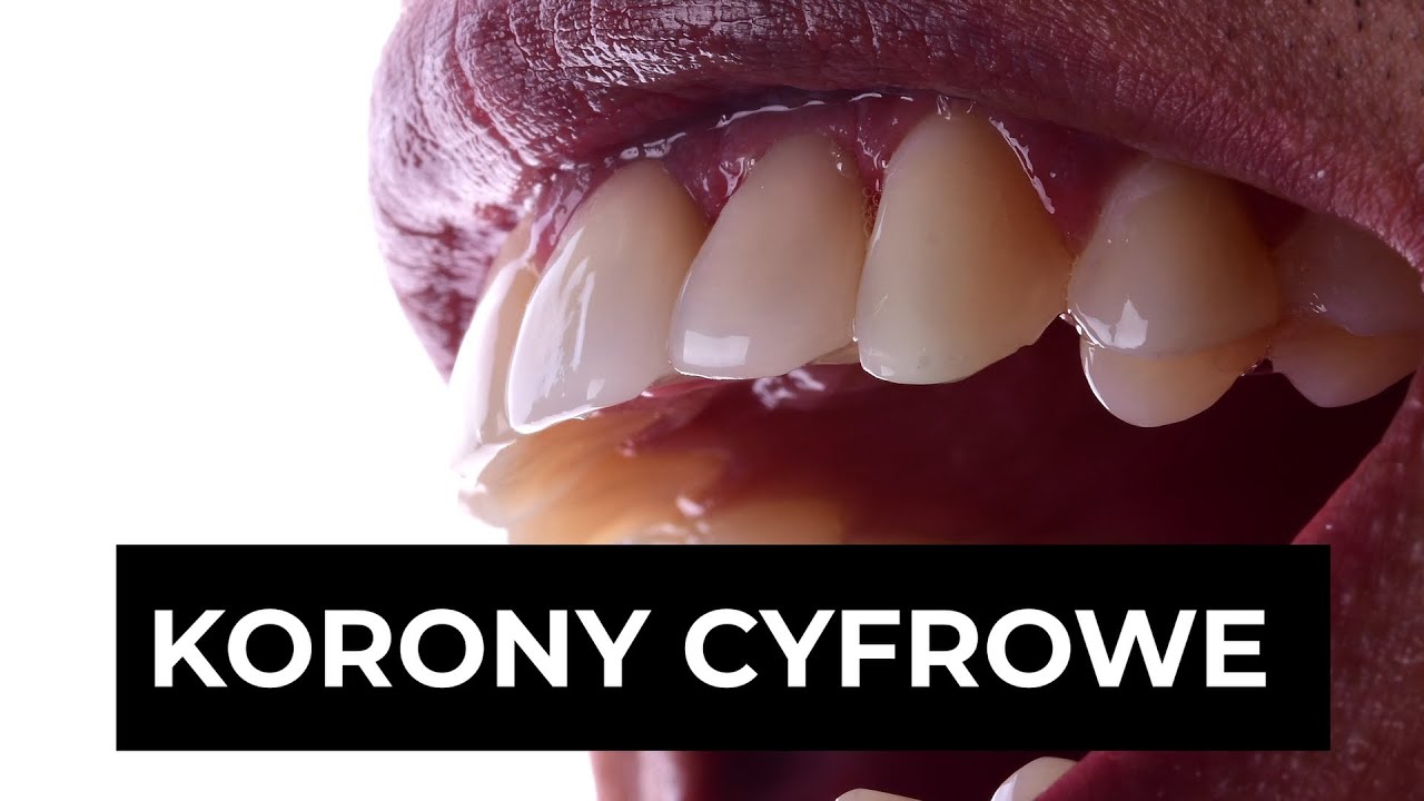 Czym są KORONY CYFROWE ?  Lek. dent. Kamil Szewczyk wyjaśnia