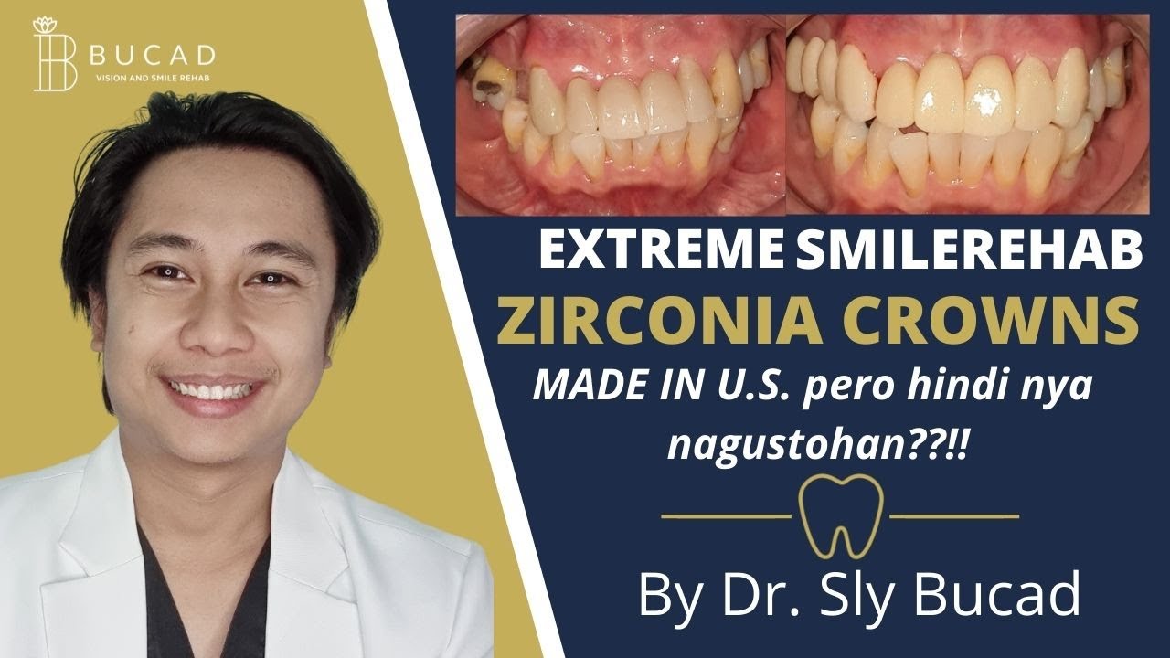 NAGPAGAWA SA U.S. pero HINDI NYA NAGUSTOHAN Extreme Smile Rehab by Dr. Sly Bucad