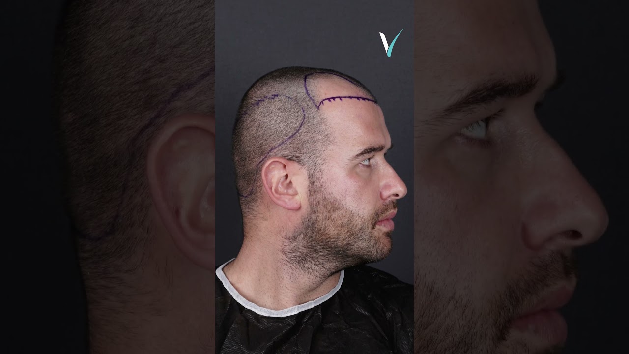 1 Year Hair Transplant Turkey Before After 