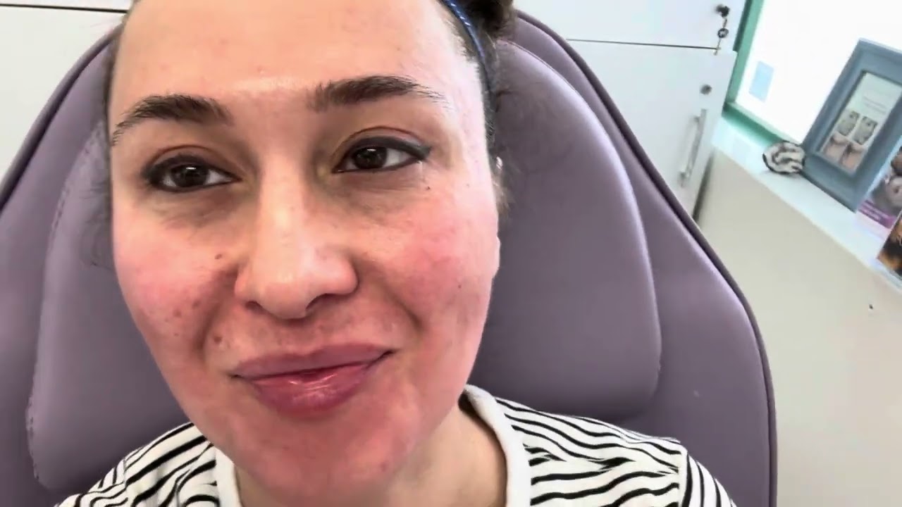 Venus Viva MD NanoFractional Radiofrequency (RF) skin resurfacing treatment, July 14, 2025