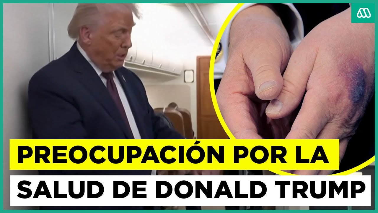 Preocupación por la salud de Donald Trump: llamaron la atención moretones en sus manos