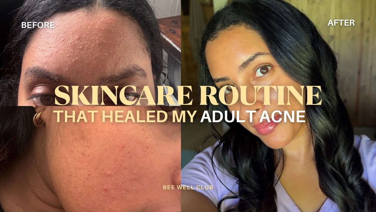 skincare routine that healed my adult acne | affordable products that *actually* work