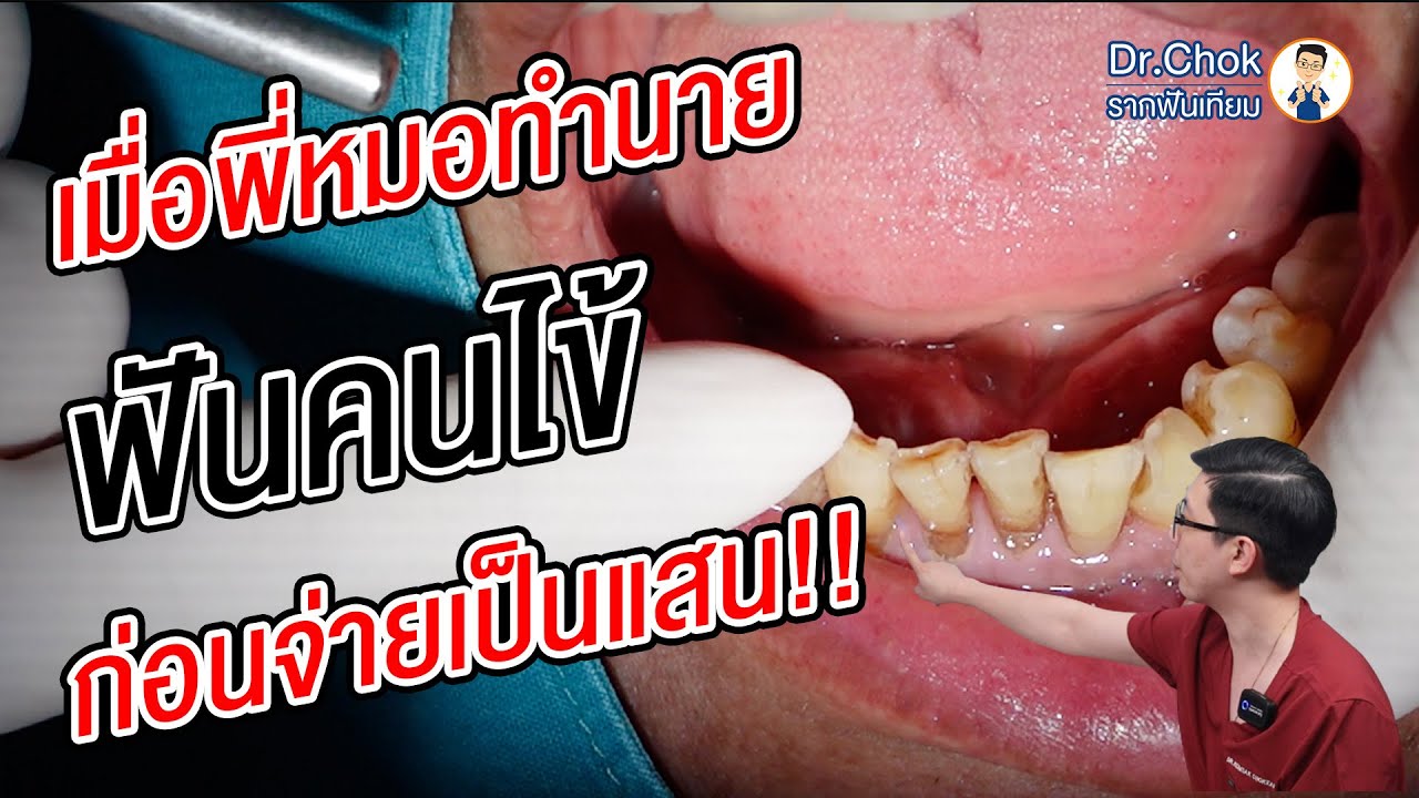 เมื่อพี่หมอ ทำนาย ฟันคนไข้ ก่อนจะเสียหลายแสน ?!! | คลายปัญหารากฟันเทียมกับหมอโชค