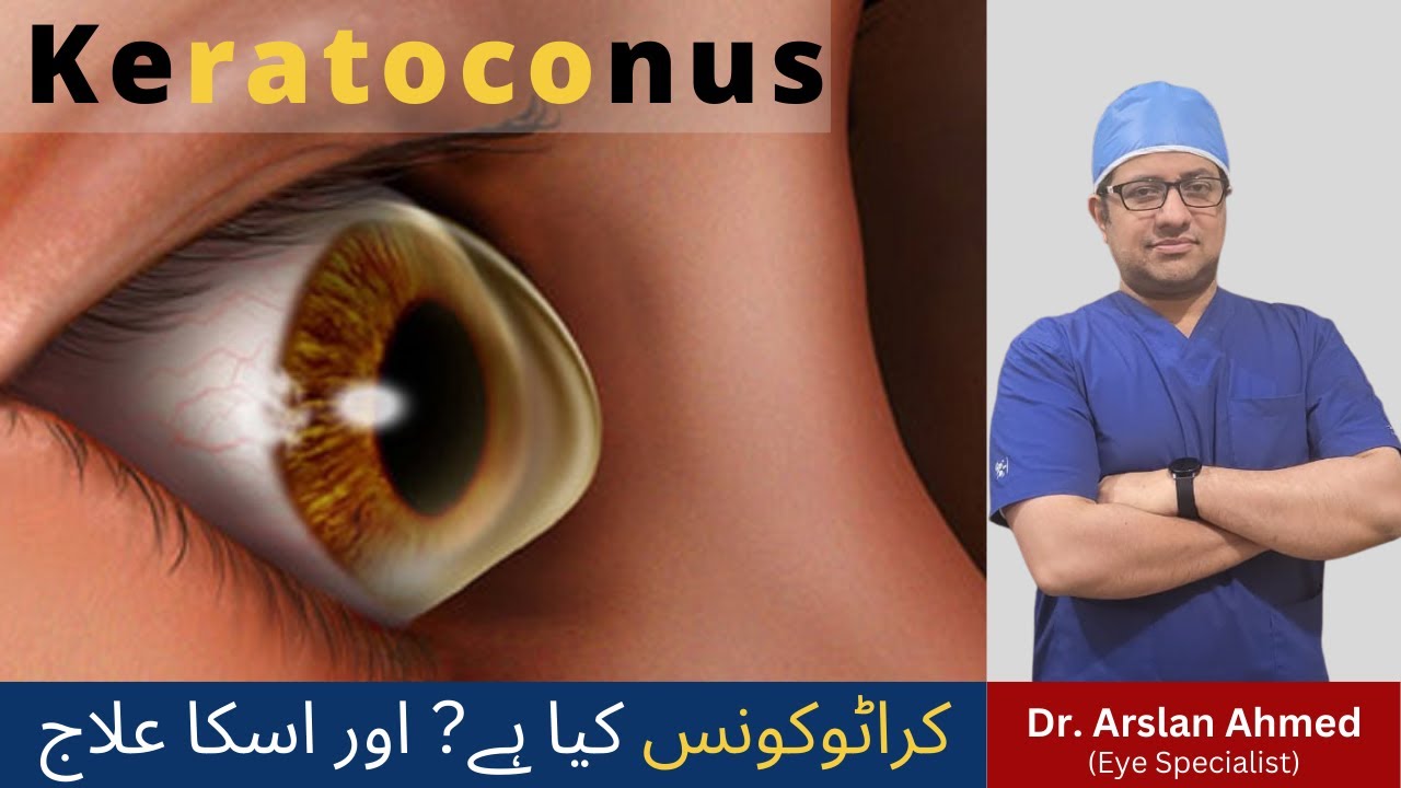 What is Keratoconus? Corneal Cross Linking | Best Eye Specialist in Lahore Pakistan Keratoconus Urdu