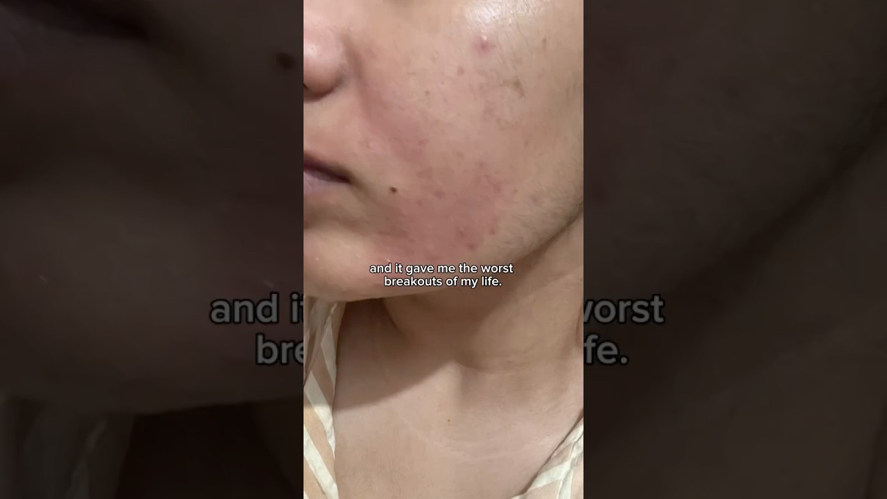 How Salicylic Acid ruined my skin 💔#shorts #skincare