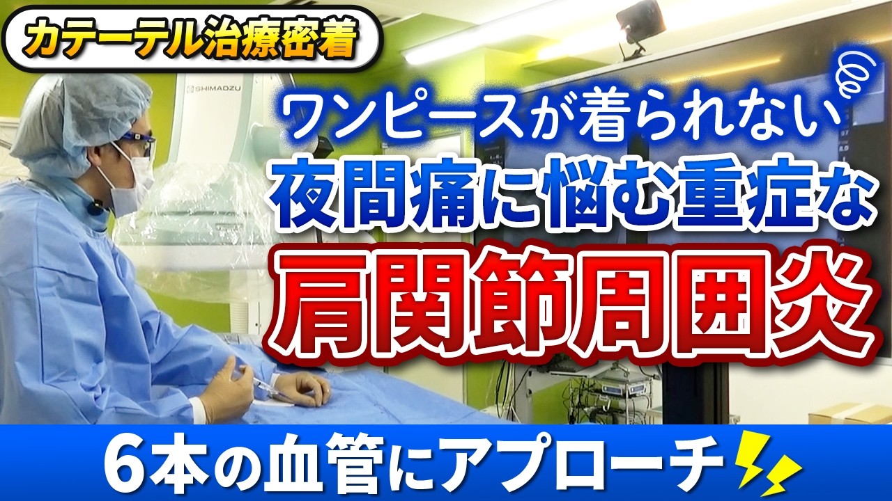【カテ密着】ワンピースが着れない重度の五十肩　肩関節周囲炎のカテーテル治療