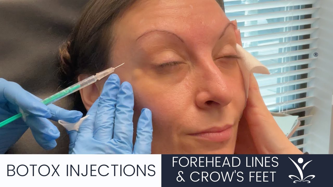 Botox Injections for Forehead Lines and Crow’s Feet