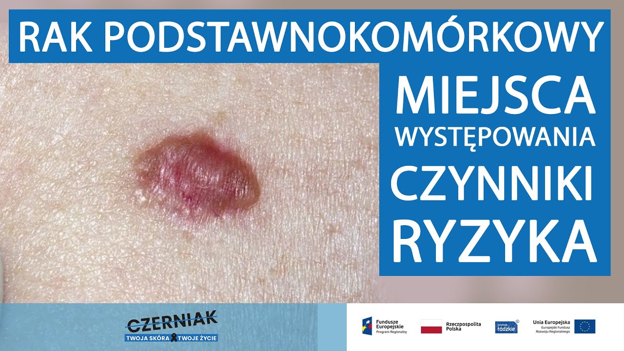 Rak podstawnokomórkowy - występowanie i czynniki ryzyka - Prof. dr hab. n. med. Agnieszka Żebrowska