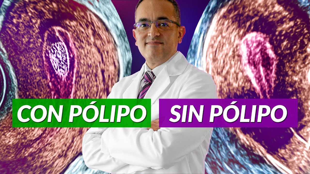 Cirugía de Pólipos [Histeroscopia vs Legrado]