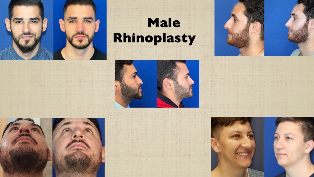 Male Rhinoplasty!